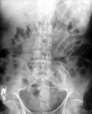 Frontal abdominal radiograph in a patient with pro