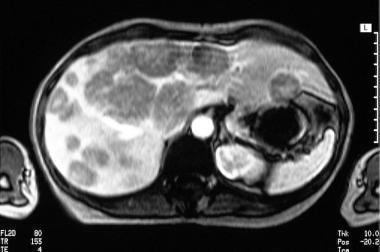 Liver, metastases. Characteristic appearance of ca