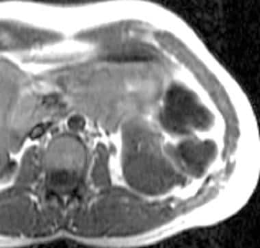 t1加权磁共振成像(MRI)。这个M