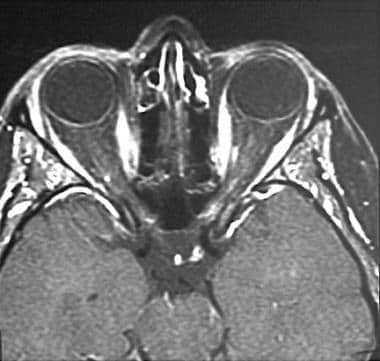 A 35-year-old woman with acute onset of left-eye p
