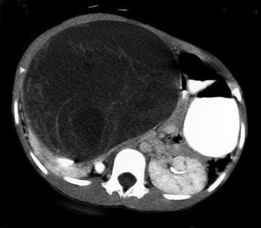 Image in a 15-year-old boy with a right-sided abdo