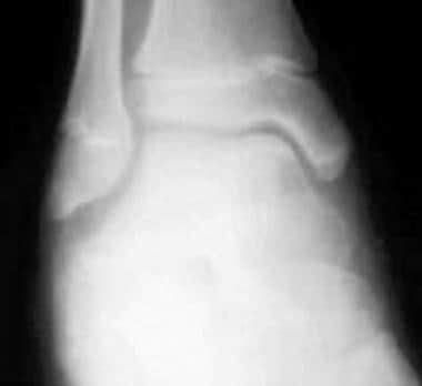 Plain radiograph of the talus in a 12-year-old boy