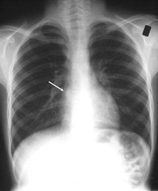 Chest radiograph in a 9-year-old boy who presented