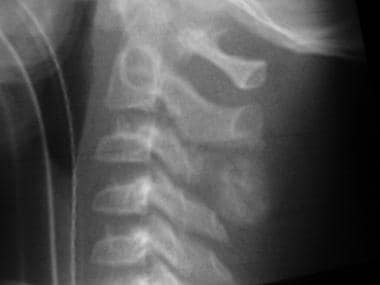 Lateral radiograph of the cervical spine in a 10-y