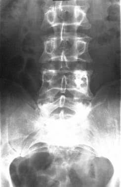 Anteroposterior radiograph of the lumbar spine in 