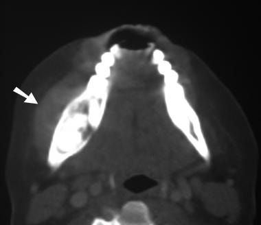 Axial computed tomography (CT) scan obtained with 