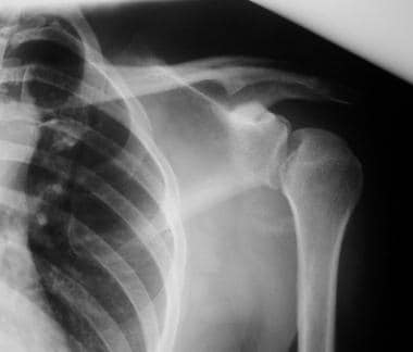 Anteroposterior radiograph of the left shoulder sh