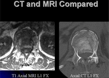 Lumbar spine trauma. Axial CT (right) and axial MR