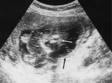 Transverse ultrasonogram through the fetal neck sh