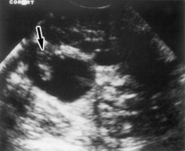 Transvaginal ultrasonogram shows the right ovary, 