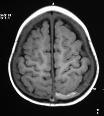 Subdural Hematoma. T1-weighted MRI of the brain sh