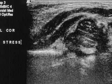 Coronal real-time sonogram of the hip obtained wit