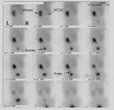 More delayed images from the same renal scanning e