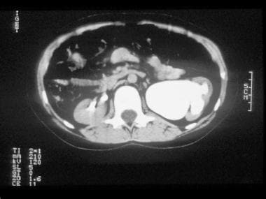 Excretory phase image from an abdominal computed t