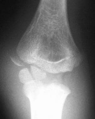 Lateral condyle fracture passing through the ossif