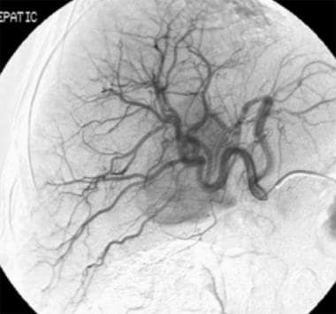 Chemoembolization. Contrast agent injection in the