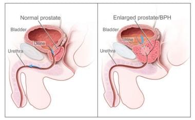 Two-panel drawing shows normal male reproductive a