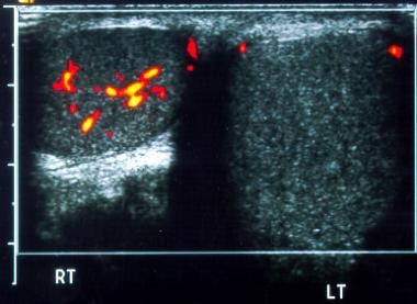 Transverse power Doppler image of both testes illu