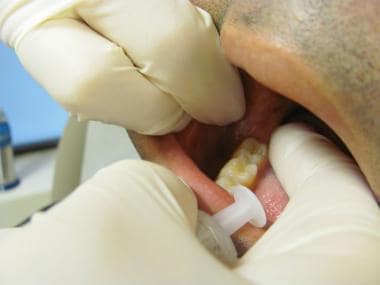 Identifying mandibular ramus 