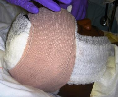 The final compressing dressing topped with an elas