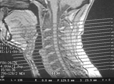 MR imaging, larynx. Sagittal localizer showing the