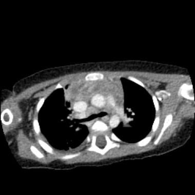 Axial CT image of a 9-year-old child with a retrop