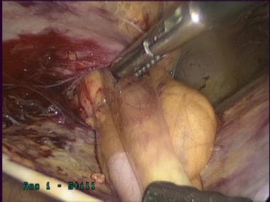Laparoscopic inguinal hernia repair: TAPP. Reducti