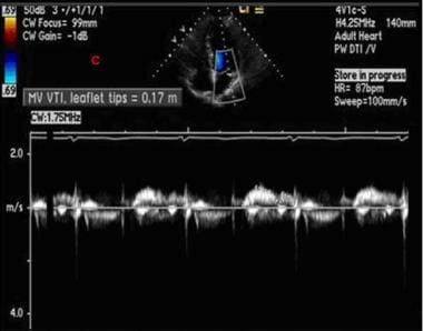 Echocardiography. This is a spectral Doppler image