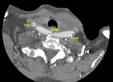 CT scan demonstrating CCA-to-CCA bypass using retr