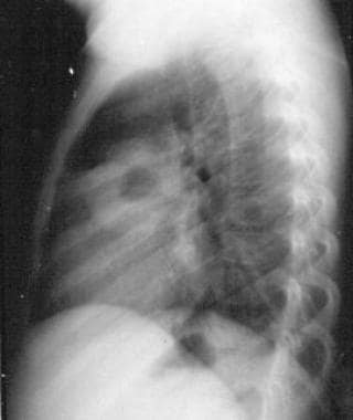 Pneumonia with pneumatocele (lateral). 