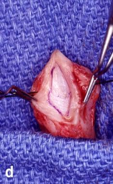 Tubularized incised plate (TIP) technique. Urethra