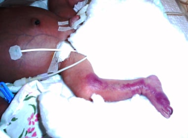 Newborn baby boy with right femoral artery lesion 