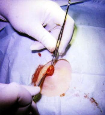 Surgical excision of a 6-cm lipoma on the back of 