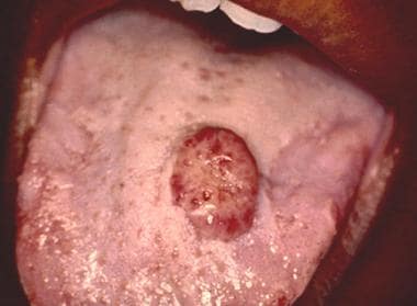 Pyogenic granuloma of the dorsal tongue in a 52-ye