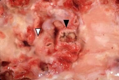 Aorta with an ulcerated plaque (black arrowhead) o