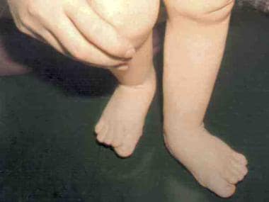 Broad great toes in a child with Rubinstein-Taybi 