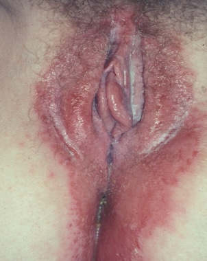Vaginal candidiasis. Erythema, edema, and cheesy w