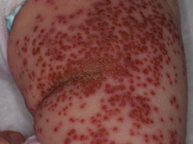 Erythematous vesicles characteristic of eczema her