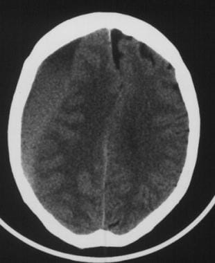 Subacute subdural hematoma. The crescent-shaped cl