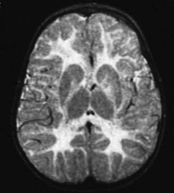 T2-weighted magnetic resonance imaging (MRI) scan 