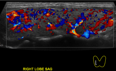 Thyroiditis on Doppler imaging of the right thyroi