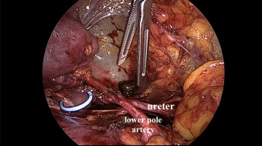 Retroperitoneal laparoscopic dissection showing UP