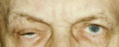 Patient with myasthenia gravis. Right lid is more 