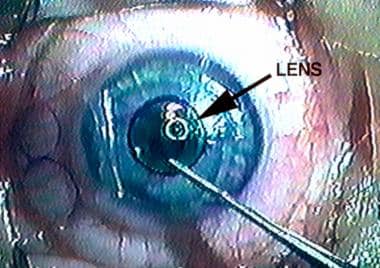 LASIK lens on the corneal stroma during laser abla