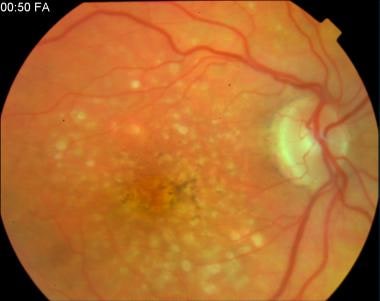 A more advanced case of dry age-related macular de
