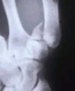 Radiograph of a Bennett fracture. 