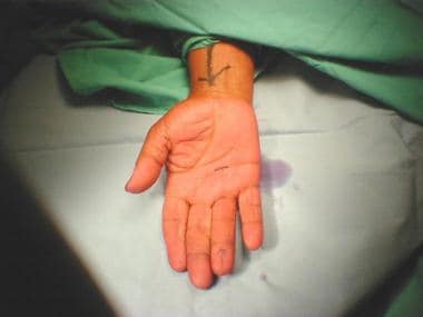 Incision marked out in distal palmar crease for su