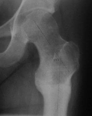Follow-up radiographs demonstrate a well-healed os