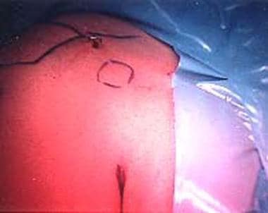 Cosmetically ideal modified axillary incision for 