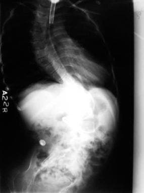 Spinal muscle atrophy. By age 9 years, this patien